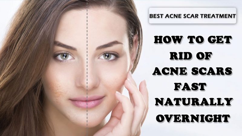 How To Get Rid Of Acne Scars : According To Dermatologists