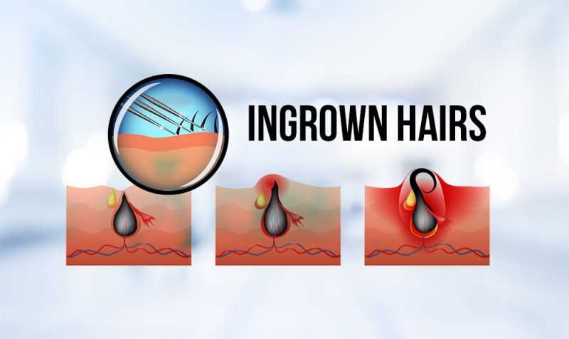 How To Get Rid Of Ingrown Hairs (Causes, Prevention, and Removal)