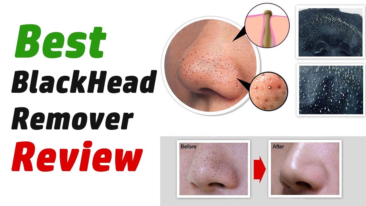 The 17 Best Blackhead Remover Products On The Market Cosmetic News